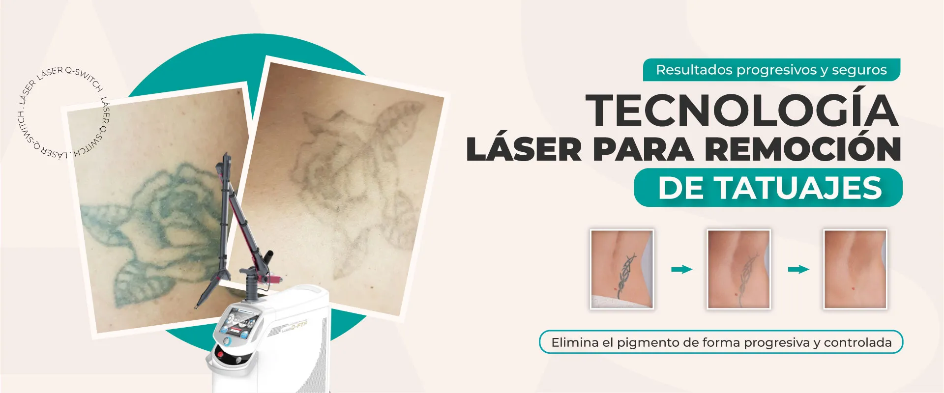 LASERTATUAJE