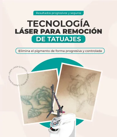 LASERTATUAJE